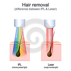 hair removal. Laser vs Intense Pulsed Light (IPL