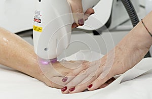 Hair removal photo