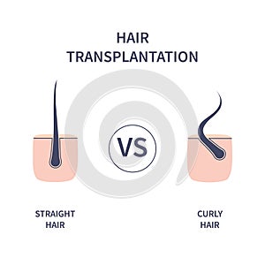 Hair transplantation for curly versus straight hair