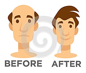 Hair transplantation before and after effect bald man