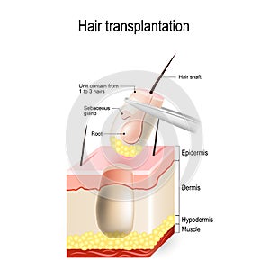 Hair transplantation photo