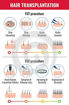 Hair Transplantation Infographics