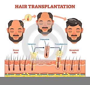 Hair Transplantation procedure diagram with steps