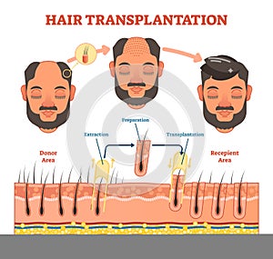 Hair Transplantation procedure diagram with steps photo