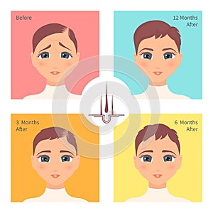 Hair transplantation surgery result in women after three, six and twelve months