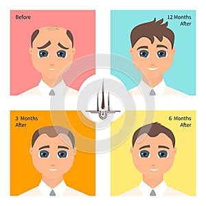 Hair transplantation surgery result in men after three, six and twelve months