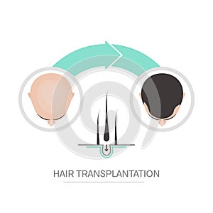 Hair transplantation poster