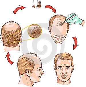 Hair transplantation photo