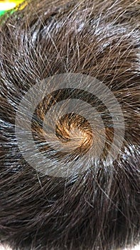 Hair whorl which is believed to determine personality