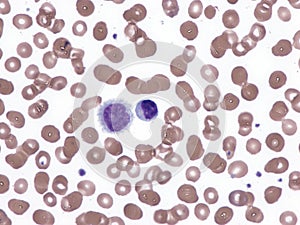 Hairy cell leukemia.