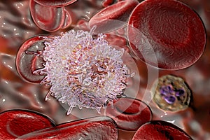 Hairy cell leukemia, 3D illustration