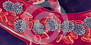Hairy cell leukemia photo