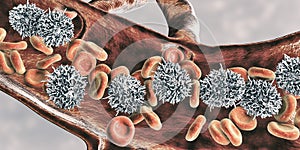 Hairy cell leukemia photo