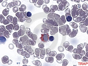 Hairy cell leukemia. TRAP-positive. photo