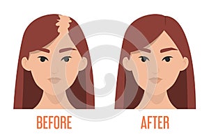 Hait transplantation before and after vector isolated