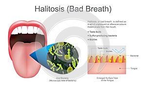 Halitosis bad breath. Education info graphic. Vector design. photo