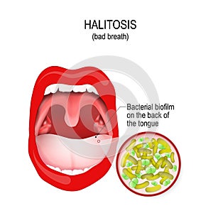 Halitosis. Bad breath photo