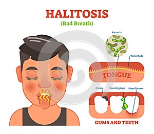 Halitosis. Bad breath vector illustration diagram poster. photo