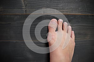 Hallux valgus, bunion in foot