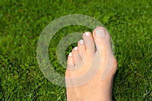 Hallux valgus, bunion in woman foot on grass background