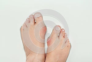 Hallux valgus, bunion in woman foot on white background