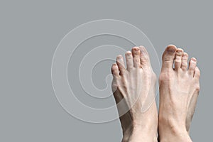 Hallux valgus, bursitis of the foot on a gray background. Deformation of the joints of the foot.