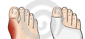 Hallux valgus is the commonest forefoot deformity