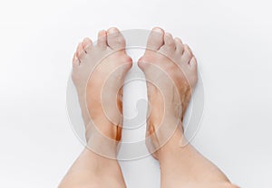 Hallux valgus on female legs close-up on a white isolated background. Deformity of the foot joint. Concept of the