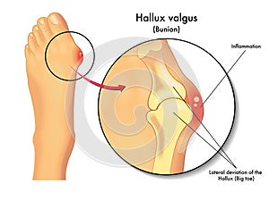 Hallux valgus