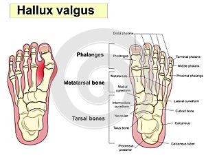 Hallux valgus text. Anatomy. Human foot bones. Signatures, also for clinics