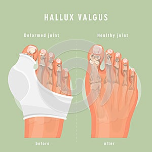 Hallux valgus vector medicine banner.