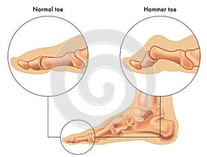 Hammer toe