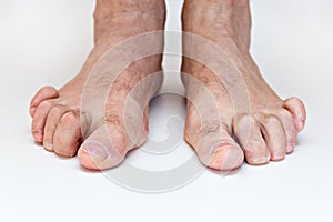 Hammer toe feet photo