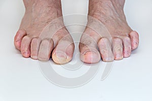 Hammer toe feet photo