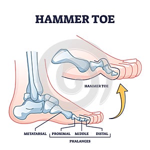 Hammer toe medical problem as foot phalanges deformation outline diagram