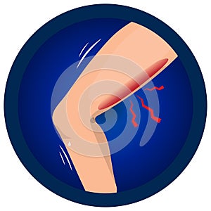 Hamstring muscle injury. . Leg muscle sport trauma. Isolated femur, fibula, tibia shown injury location.