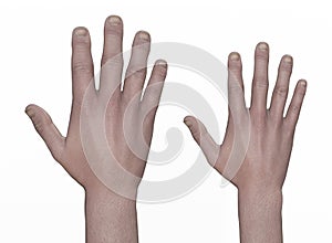 Hand with acromegaly and the same healthy hand, 3D illustration