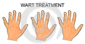 Hand affected by the wart