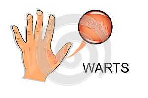 Hand affected by the wart