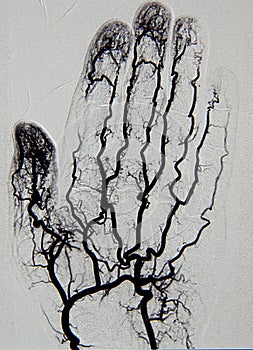 Hand angiography, arteriography photo