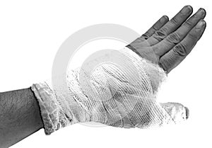 Hand with a broken thumb and white cast to immobilize the broken