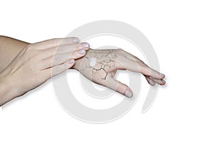 Hand with cracked skin. Cracked skin, dry skin. Skin care in winter, moisturizing the skin