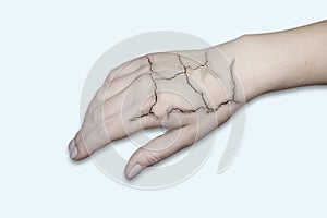 Hand with cracked skin. Cracked skin, dry skin. Skin care in winter, moisturizing the skin