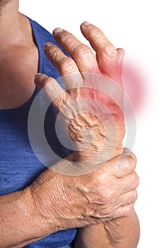 Hand Deformed From Rheumatoid Arthritis