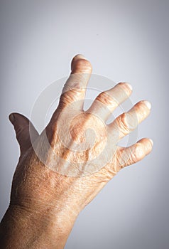 Hand Deformed From Rheumatoid Arthritis