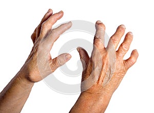 Hand Deformed From Rheumatoid Arthritis