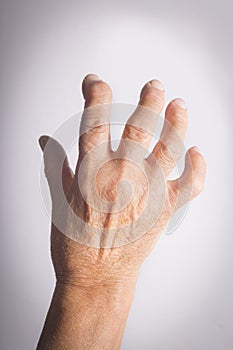 Hand Deformed From Rheumatoid Arthritis