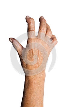 Hand Deformed From Rheumatoid Arthritis