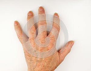 Hand Deformed From Rheumatoid Arthritis