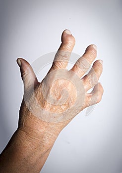 Hand Deformed From Rheumatoid Arthritis photo